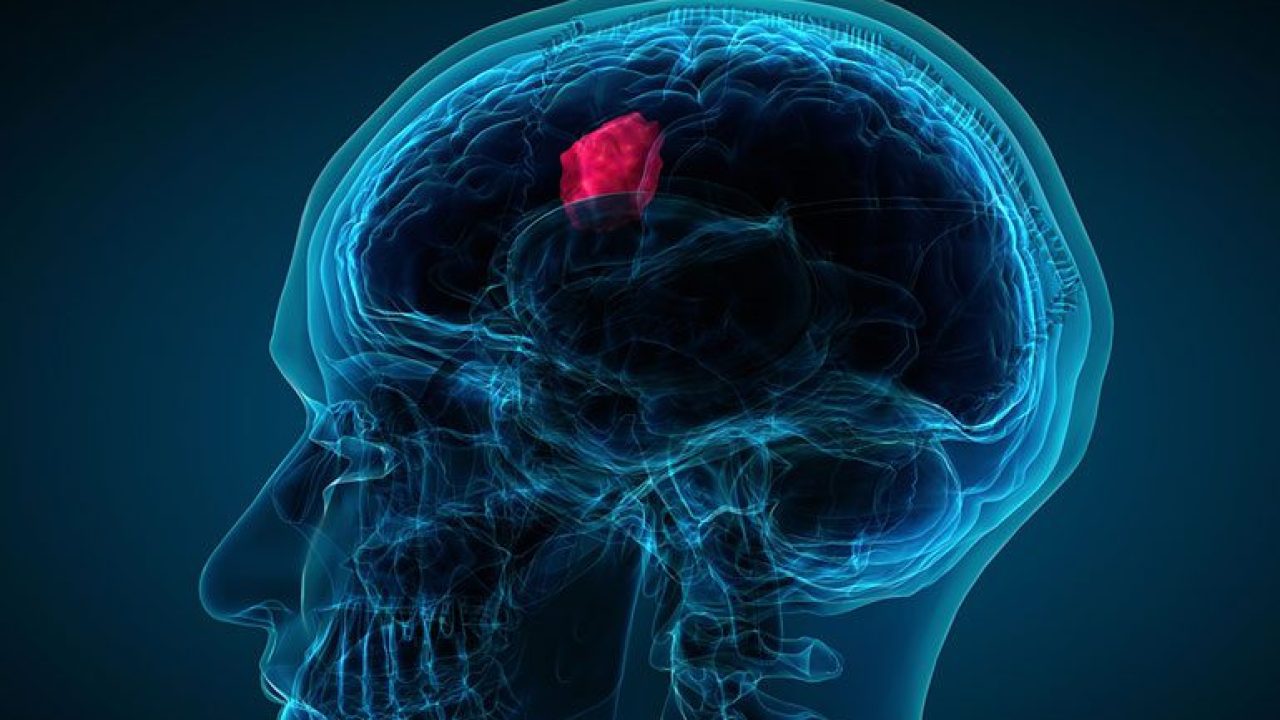 brainTumor-475447149-770x533-1